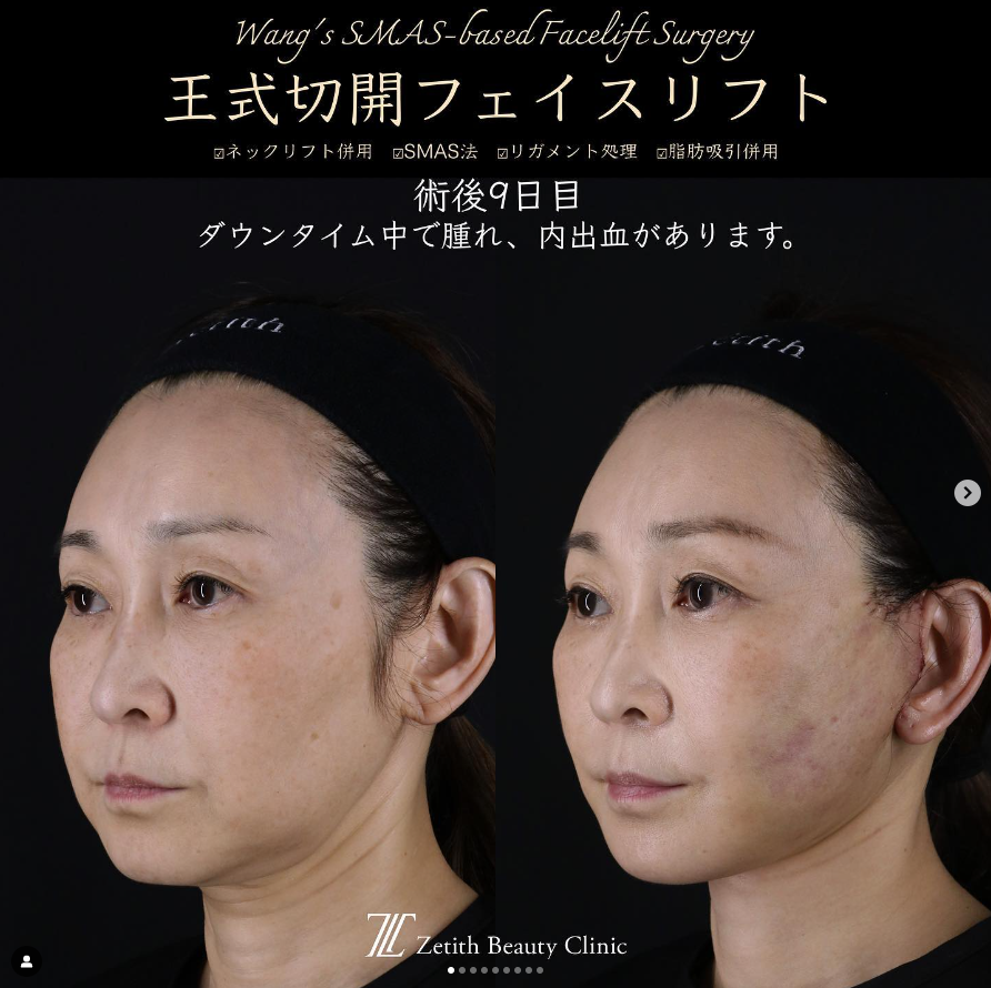 王医師による切開リフトの施術前／施術後9日