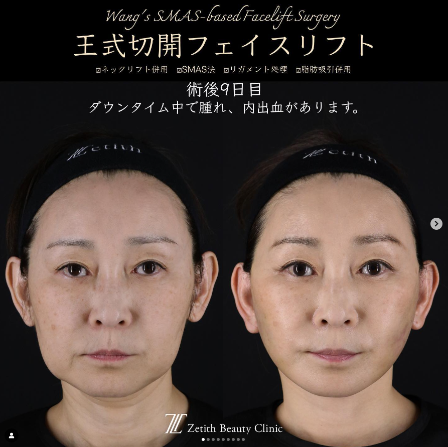 王医師による切開リフトの施術前／施術後9日 Sau 