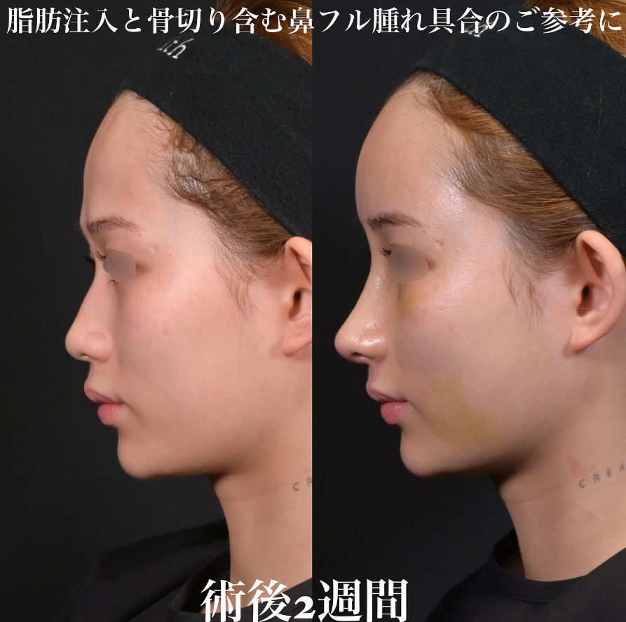 鉄医師による鼻整形の施術前／施術後2週間
