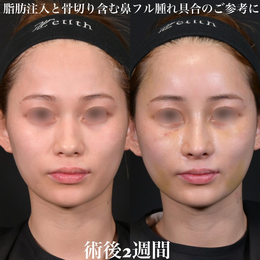 鉄医師による鼻整形の施術前／施術後2週間 หลัง 