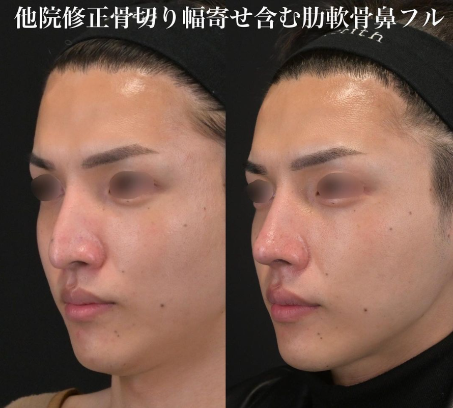 鉄医師による鼻整形の施術前／施術後3ヶ月