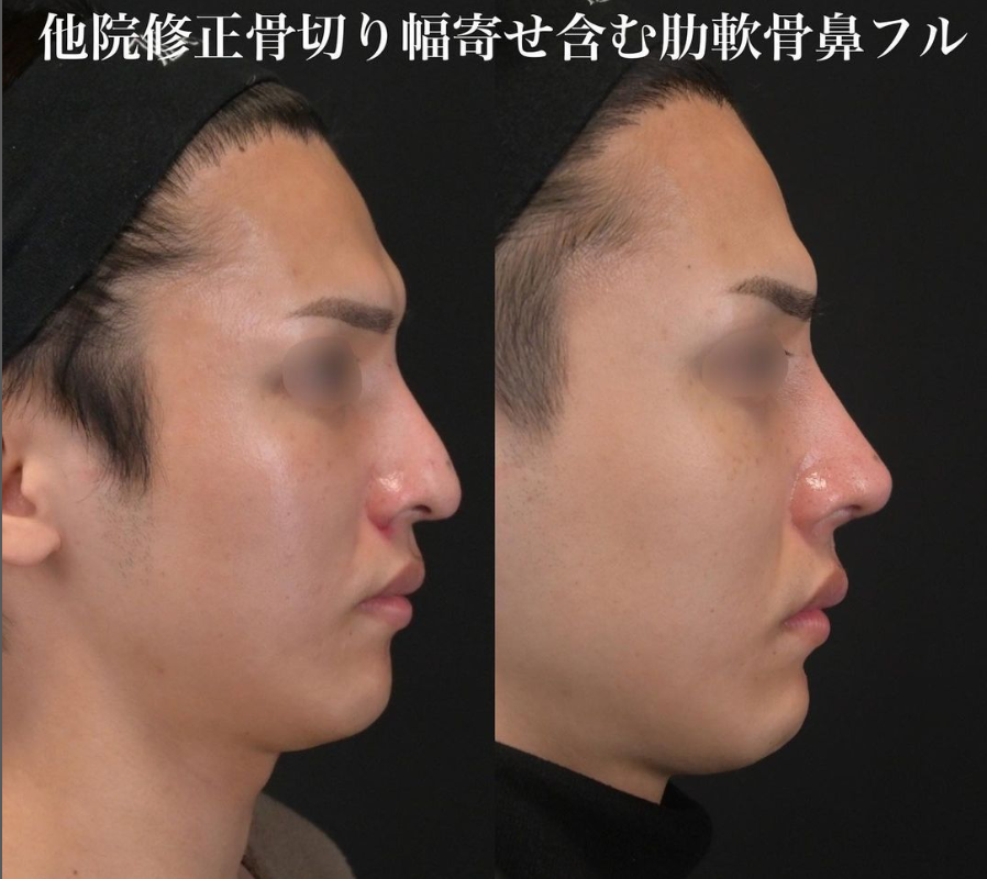 鉄医師による鼻整形の施術前／施術後3ヶ月 Дараа 