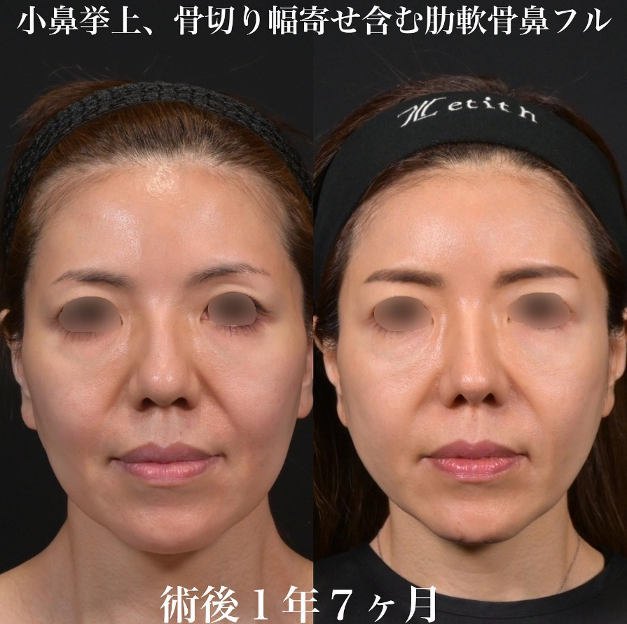 鉄医師による鼻整形の施術前／施術後1年7ヶ月