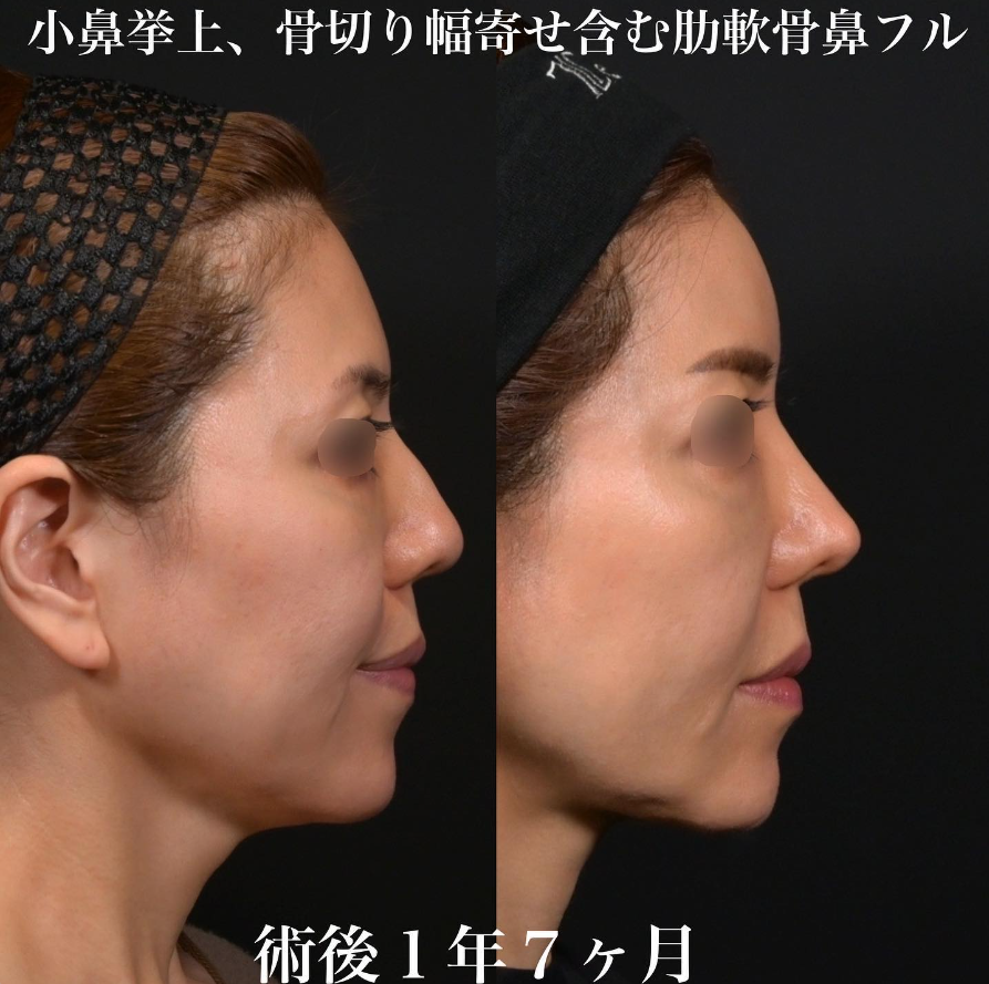 鉄医師による鼻整形の施術前／施術後1年7ヶ月 施術後 