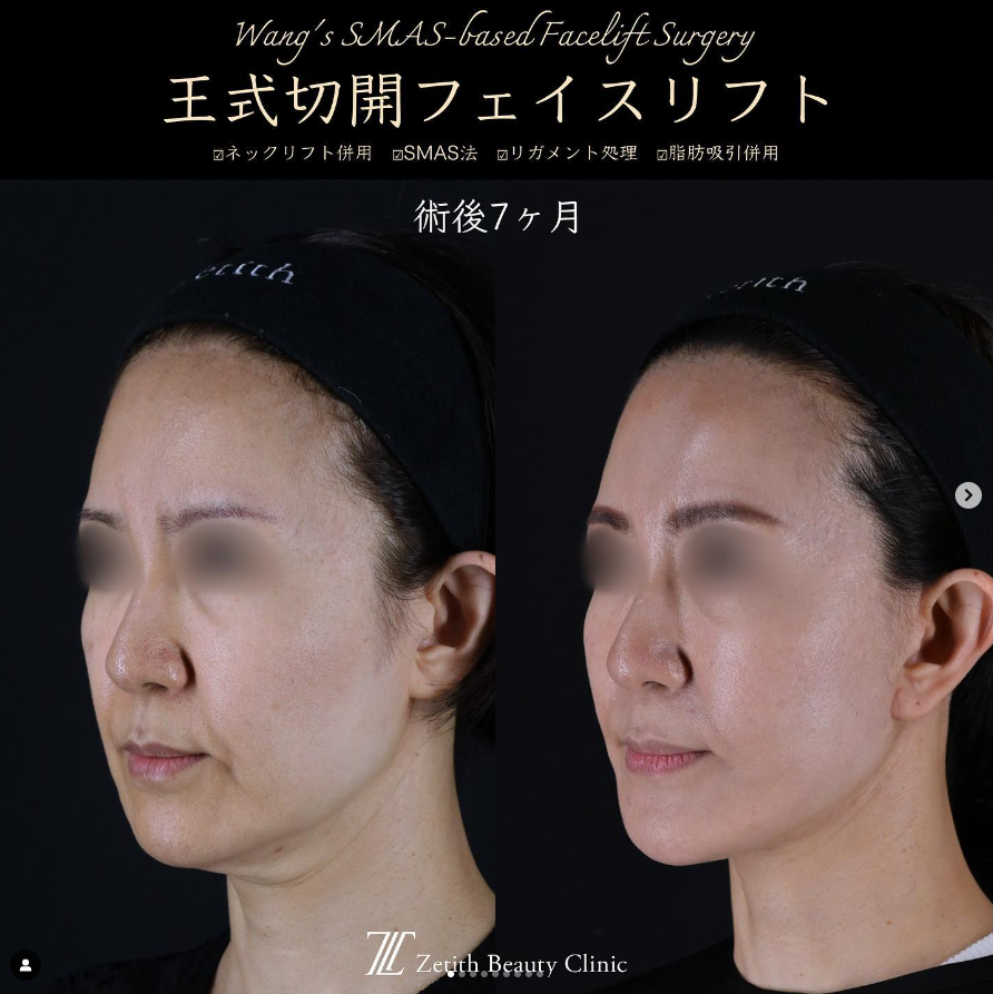 王医師による切開リフトの施術前／施術後7ヶ月