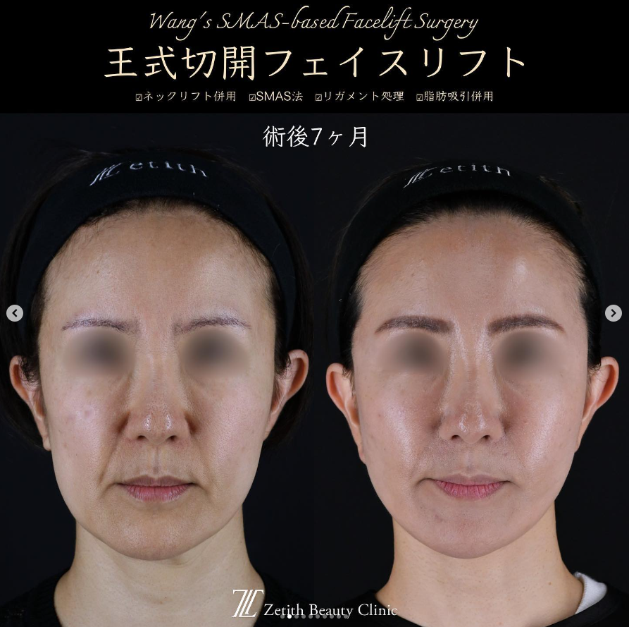 王医師による切開リフトの施術前／施術後7ヶ月 After 