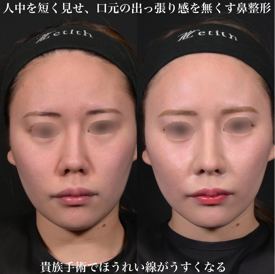 鉄医師による鼻整形の施術前／施術後2週間 施術後 