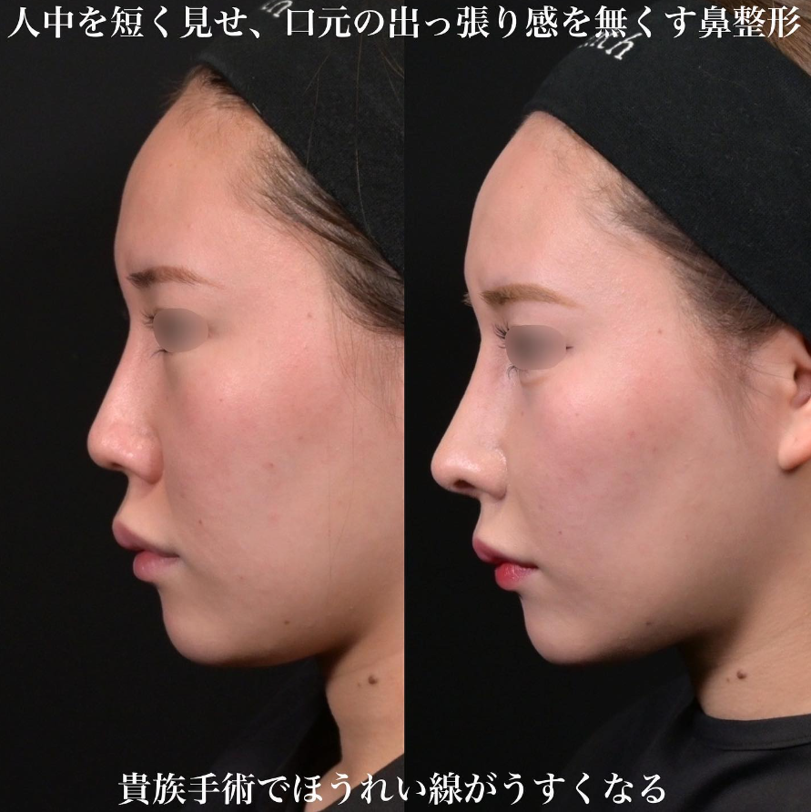 鉄医師による鼻整形の施術前／施術後2週間
