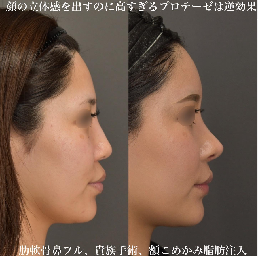 鉄医師による鼻整形の施術前／施術後3ヶ月