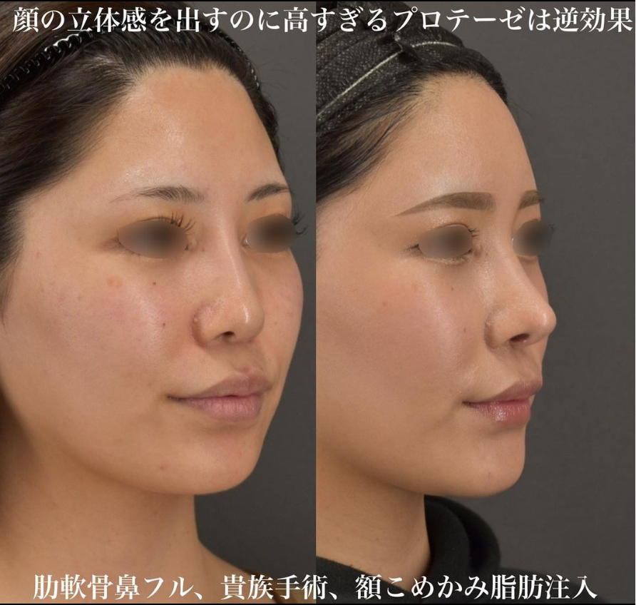鉄医師による鼻整形の施術前／施術後3ヶ月 施術後 
