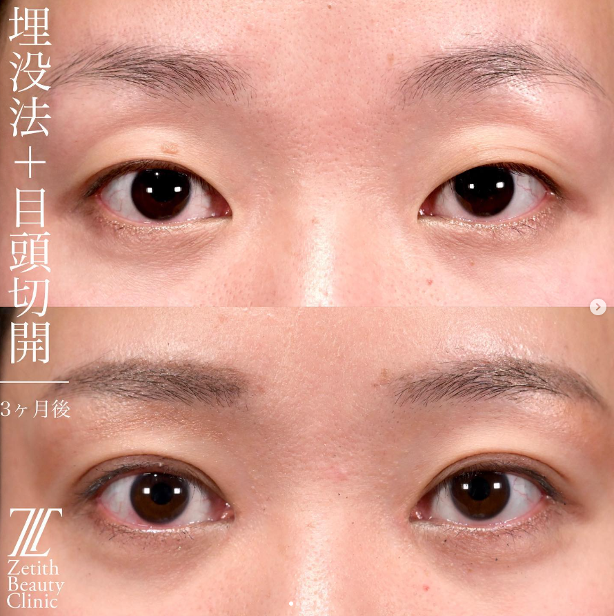 上木原医師による目元整形の施術前／施術後3ヶ月
