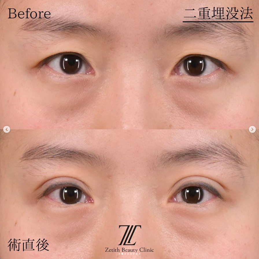 林医師による埋没法二重術の施術前／施術後1ヶ月