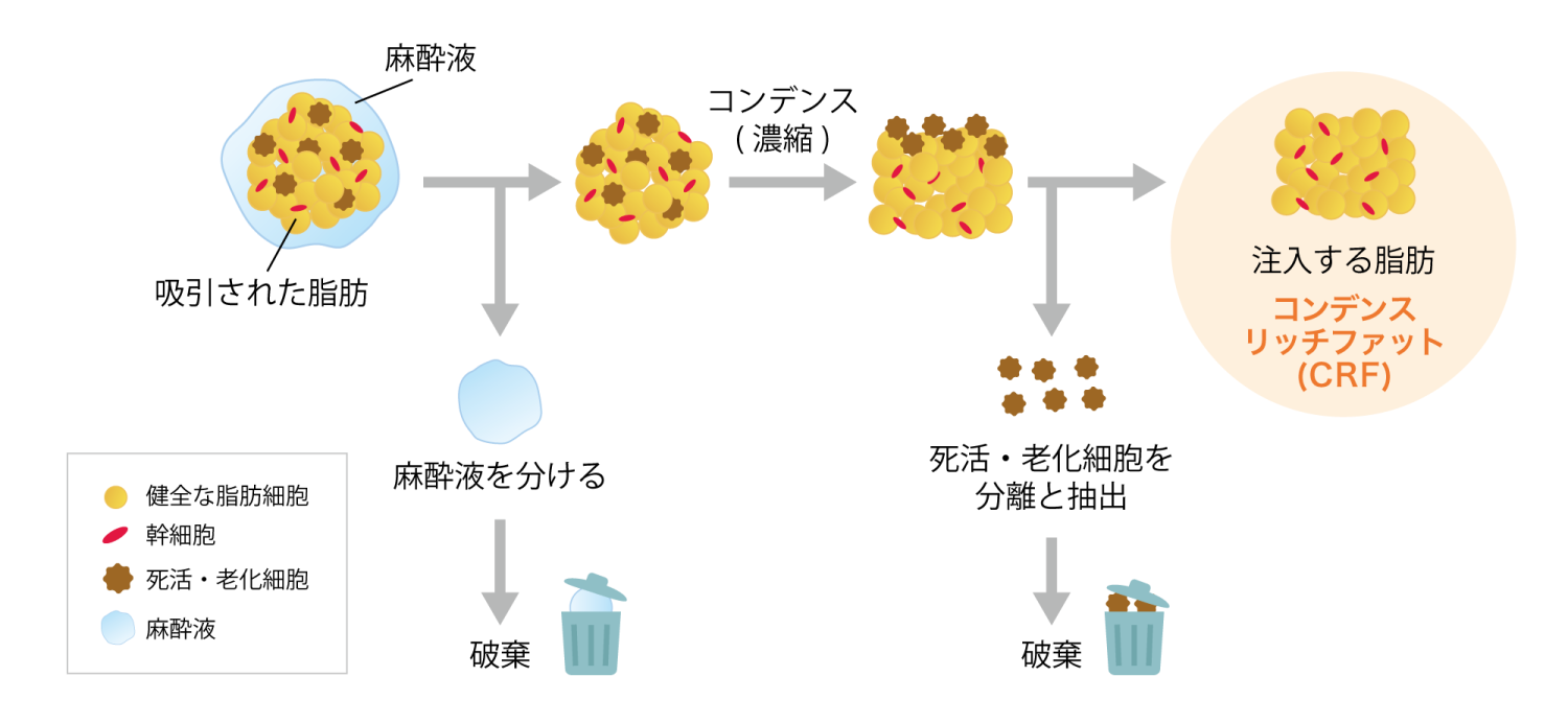 自己脂肪から良質な脂肪を採取