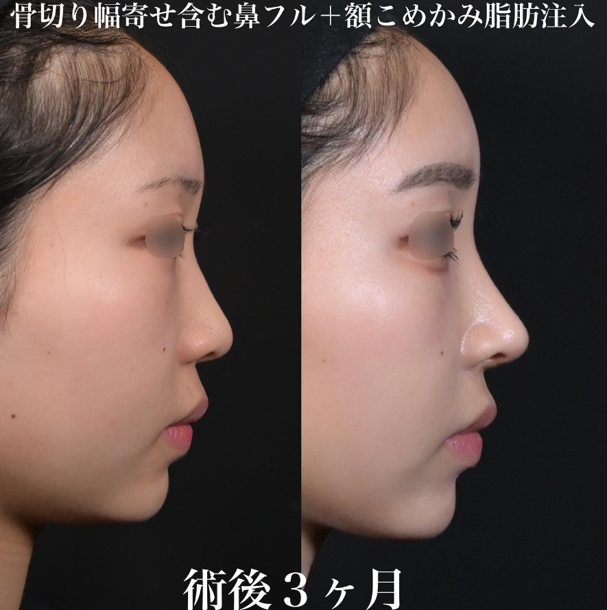 鉄医師による鼻整形の施術前／施術後3ヶ月