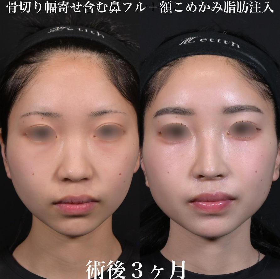 鉄医師による鼻整形の施術前／施術後3ヶ月 Дараа 