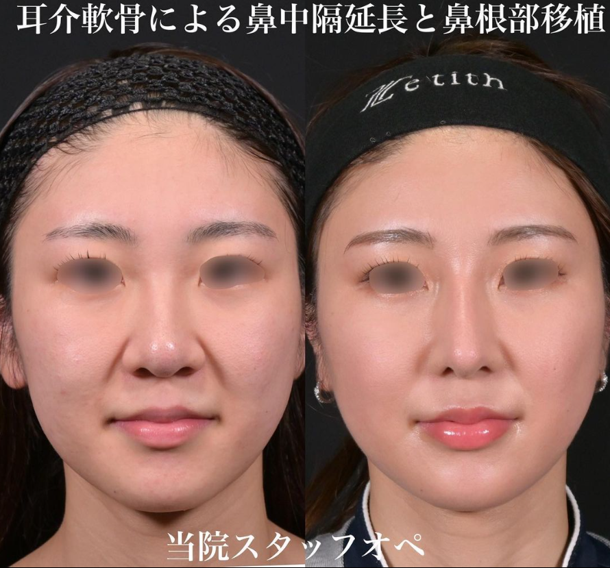 鉄医師による鼻整形の施術前／施術後6ヶ月