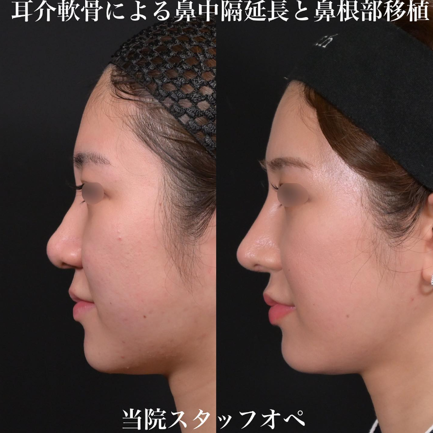鉄医師による鼻整形の施術前／施術後6ヶ月 施術後 