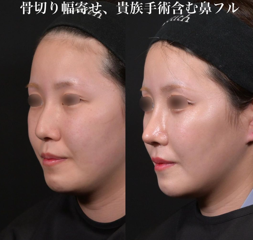 鉄医師による鼻整形の施術前／施術後2ヶ月