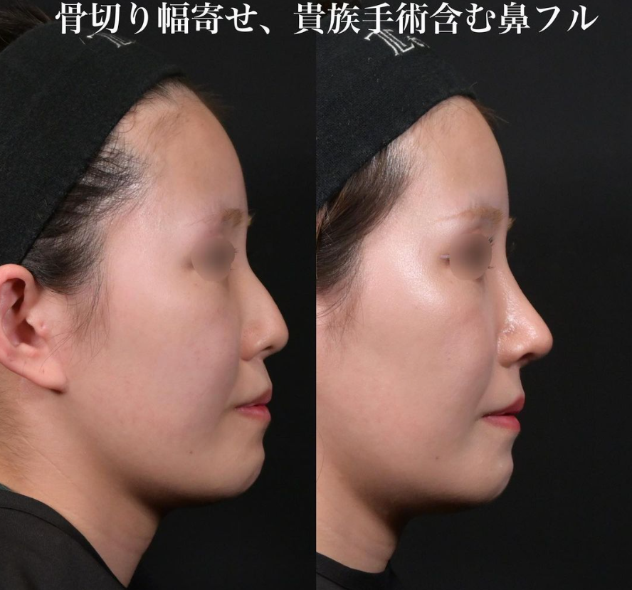 鉄医師による鼻整形の施術前／施術後2ヶ月 术后 