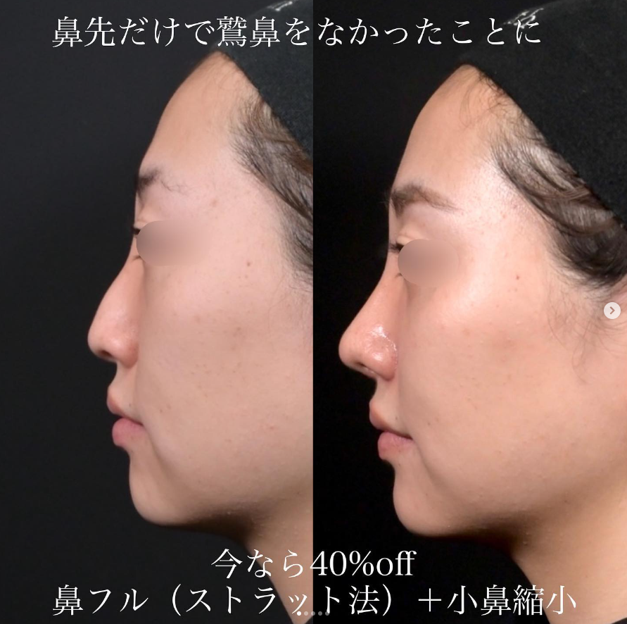 上木原医師による鼻整形の施術前／施術後1ヶ月