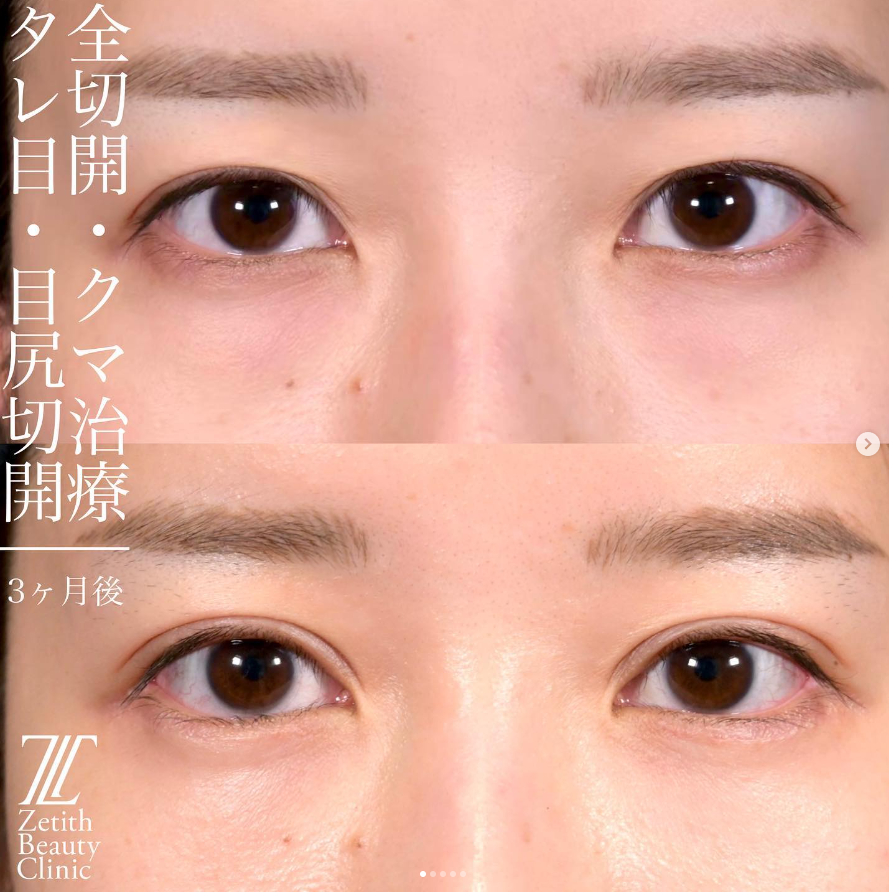 上木原医師による目元整形の施術前／施術後3ヵ月