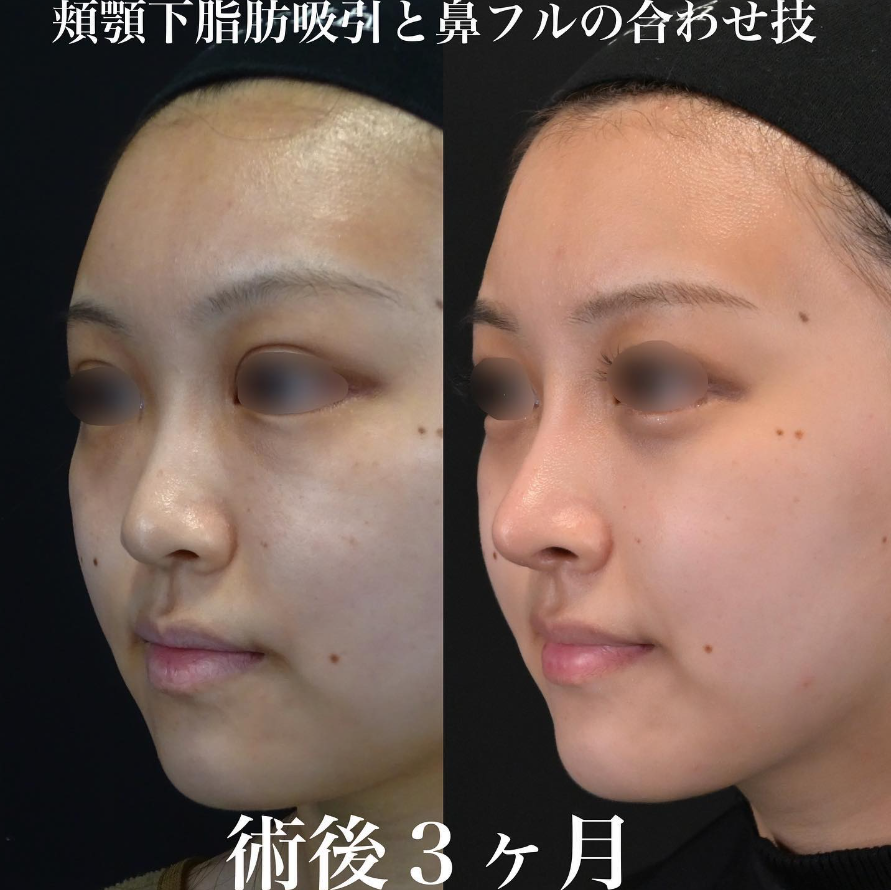 鉄医師による鼻整形の施術前／施術後3ヶ月
