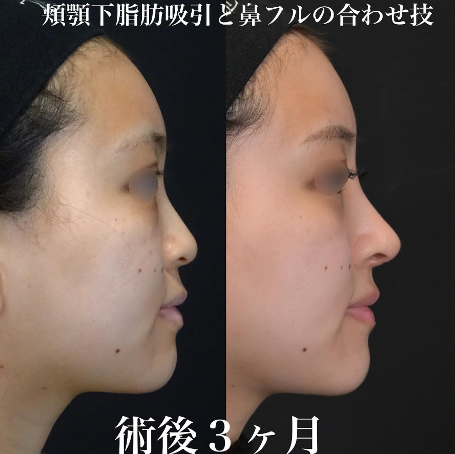 鉄医師による鼻整形の施術前／施術後3ヶ月 施術後 