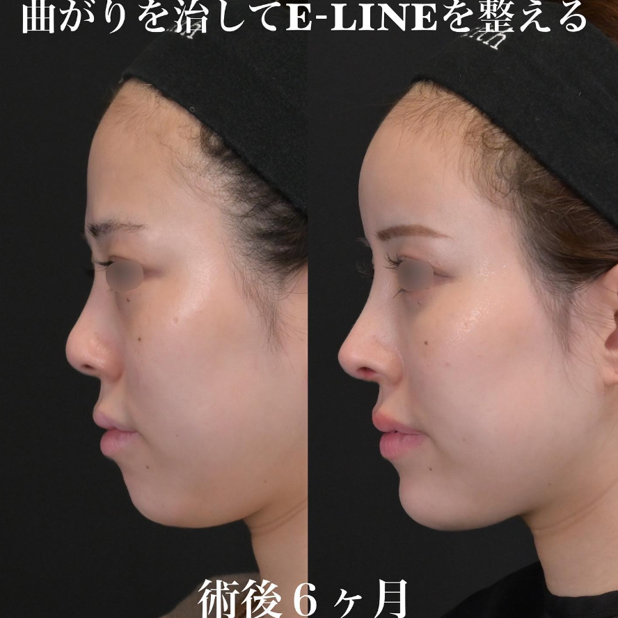 鉄医師による鼻整形の施術前／施術後6ヶ月