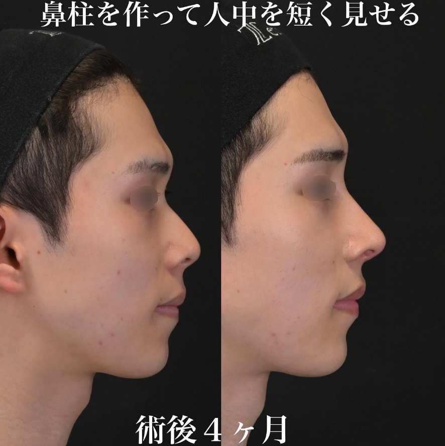 鉄医師による鼻整形の施術前／施術後4ヶ月