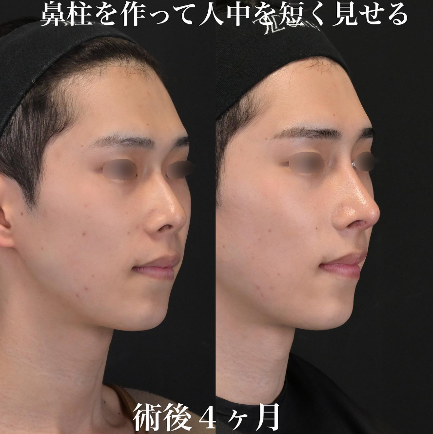 鉄医師による鼻整形の施術前／施術後4ヶ月 施術後 