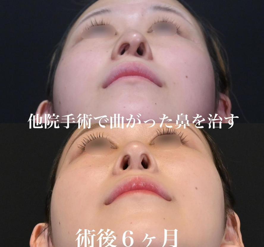 鉄医師による鼻整形の施術前／施術後6ヶ月