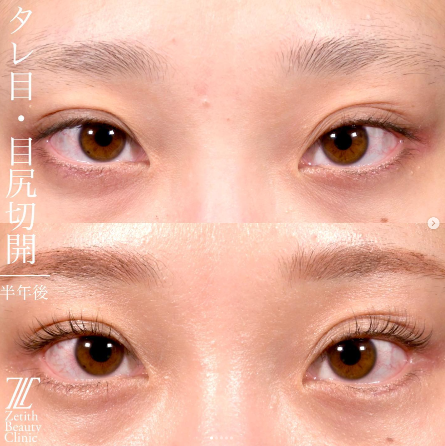上木原医師による目元整形の施術前／施術後6ヶ月