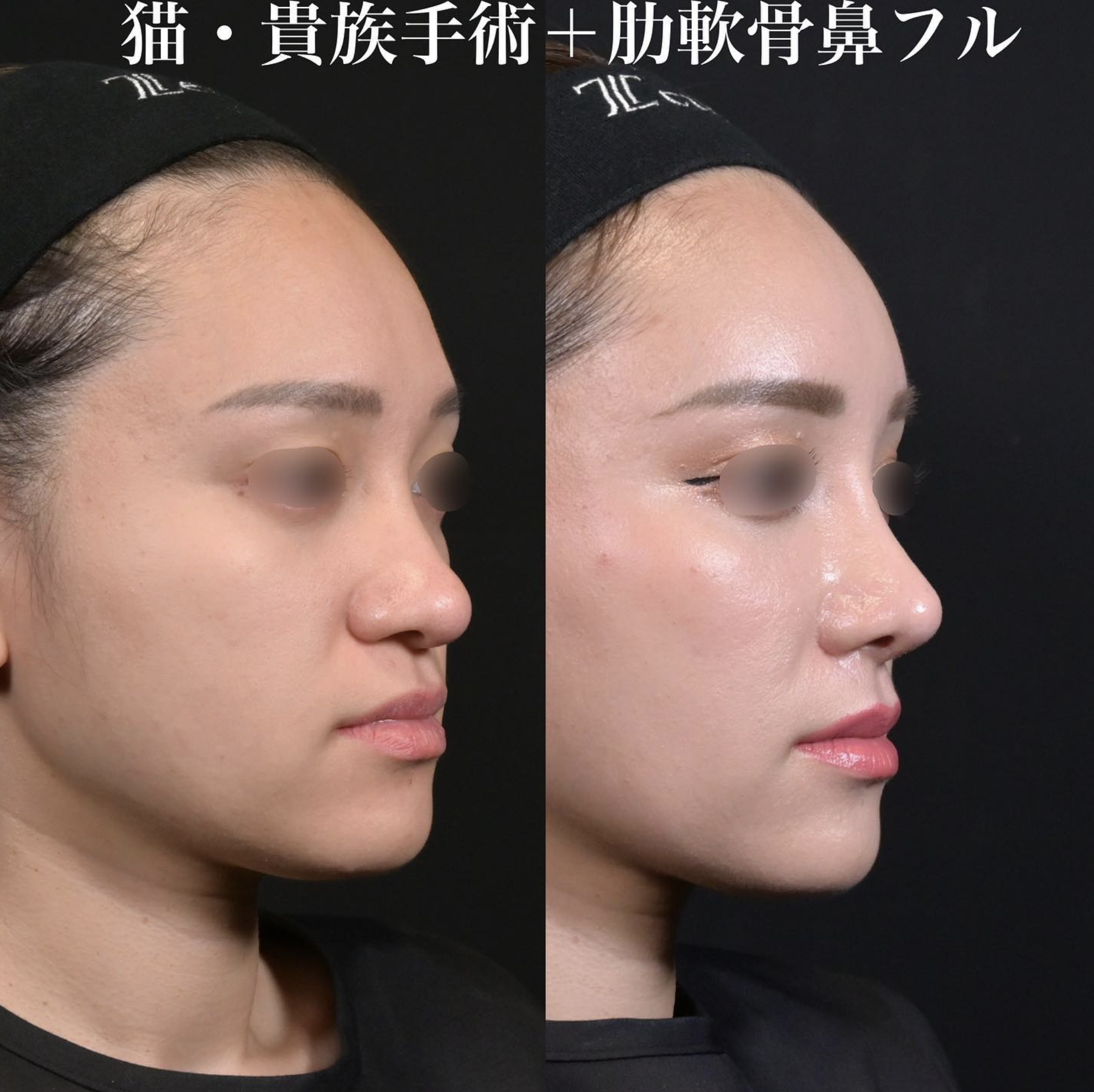 鉄医師による鼻整形の施術前／施術後１ヵ月