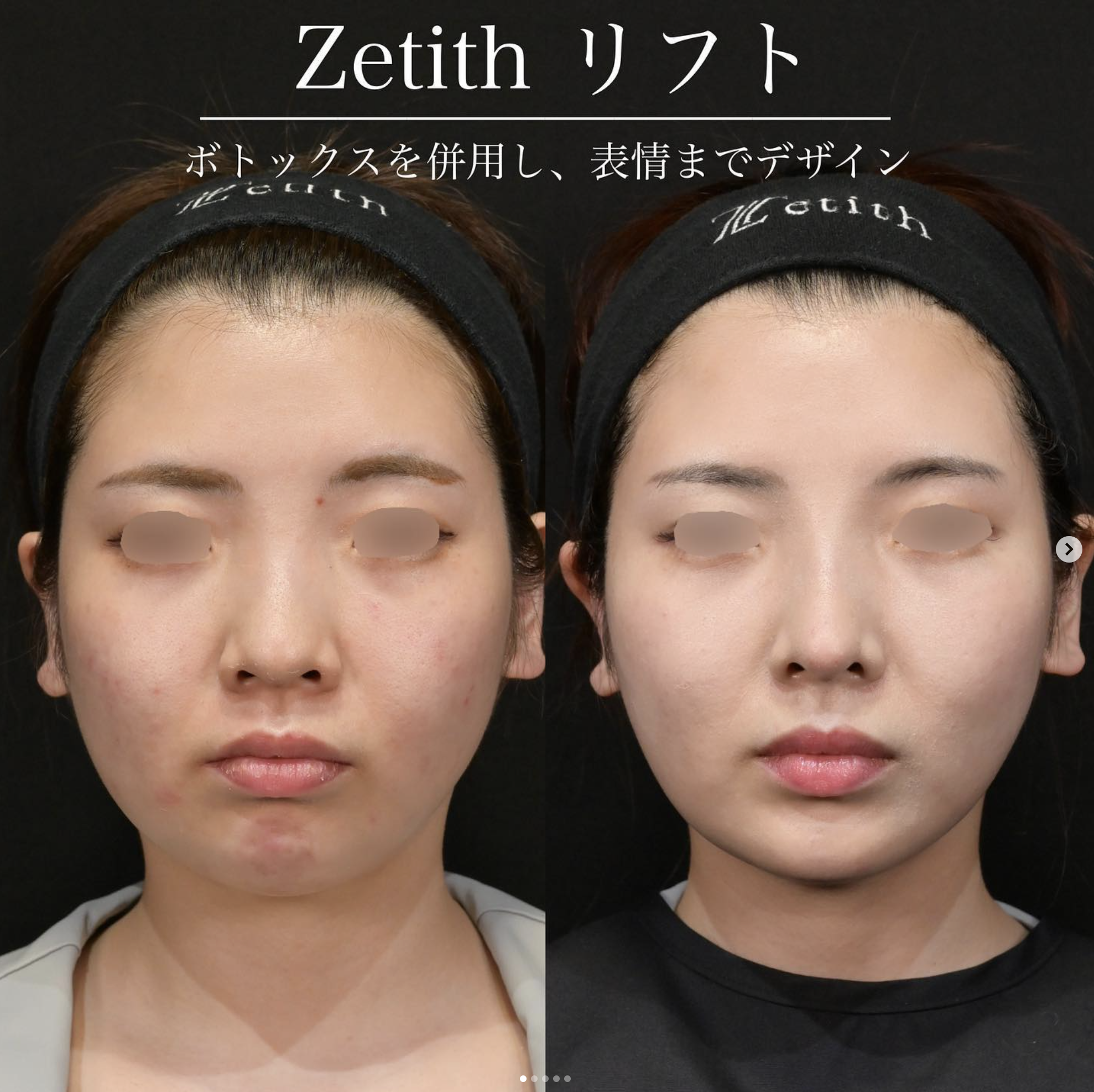 新井医師による糸リフトの施術前／施術後1ヶ月