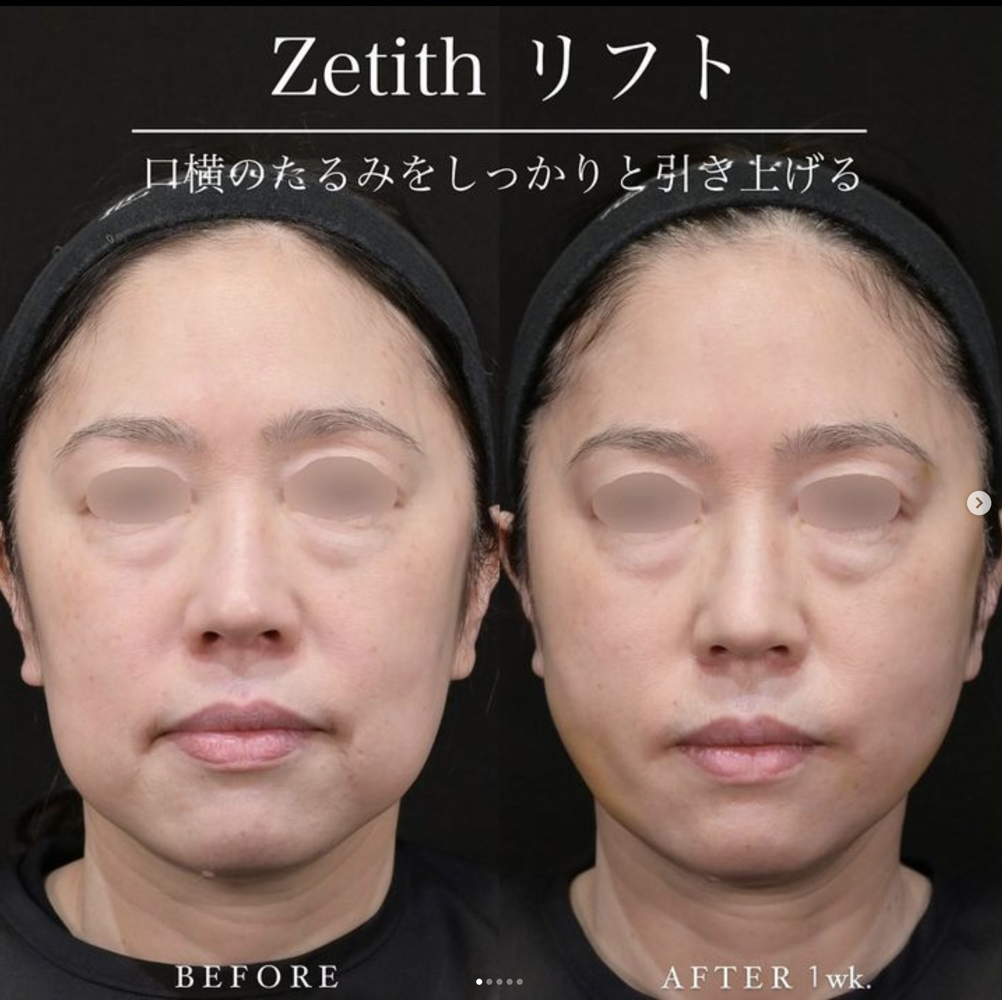 新井医師による糸リフトの施術前／施術後1週間