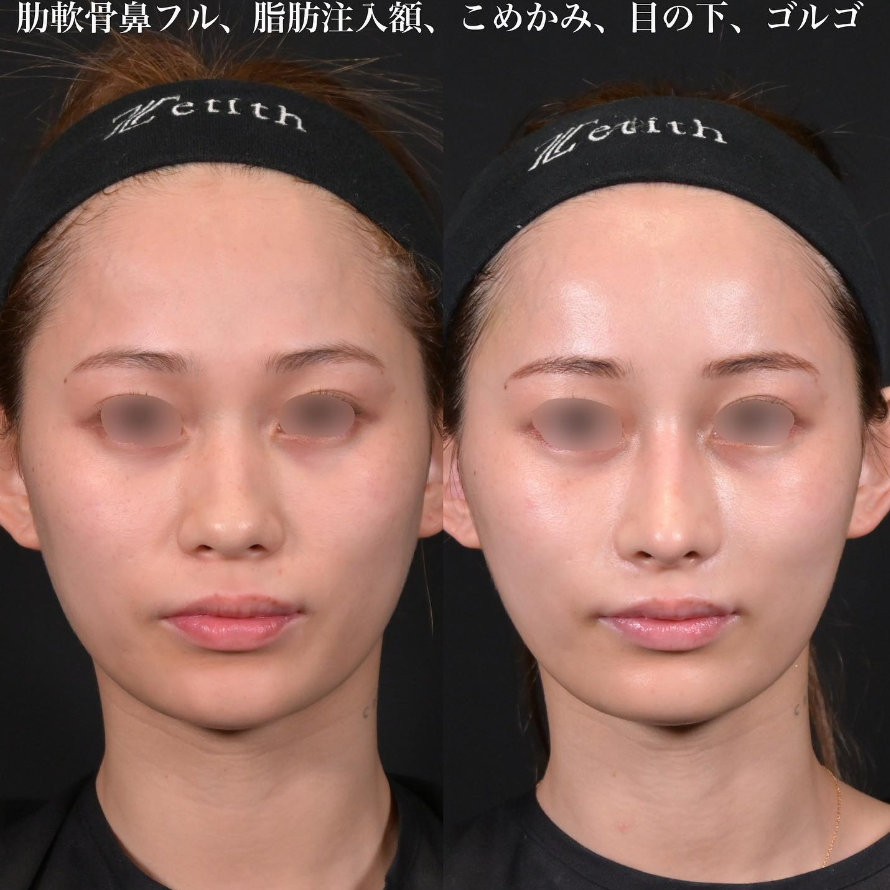鉄医師による鼻整形の施術前／施術後1ヶ月