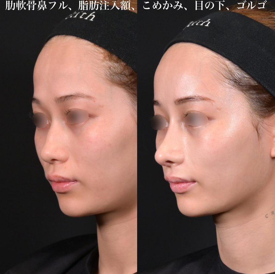鉄医師による鼻整形の施術前／施術後1ヶ月 بعد 