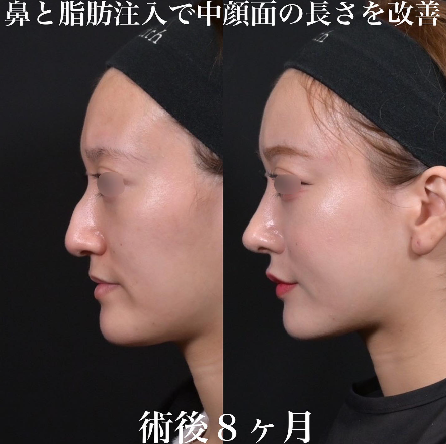 鉄医師による鼻整形の施術前／施術後8ヶ月