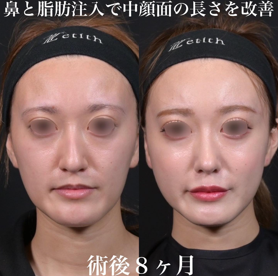 鉄医師による鼻整形の施術前／施術後8ヶ月 After 