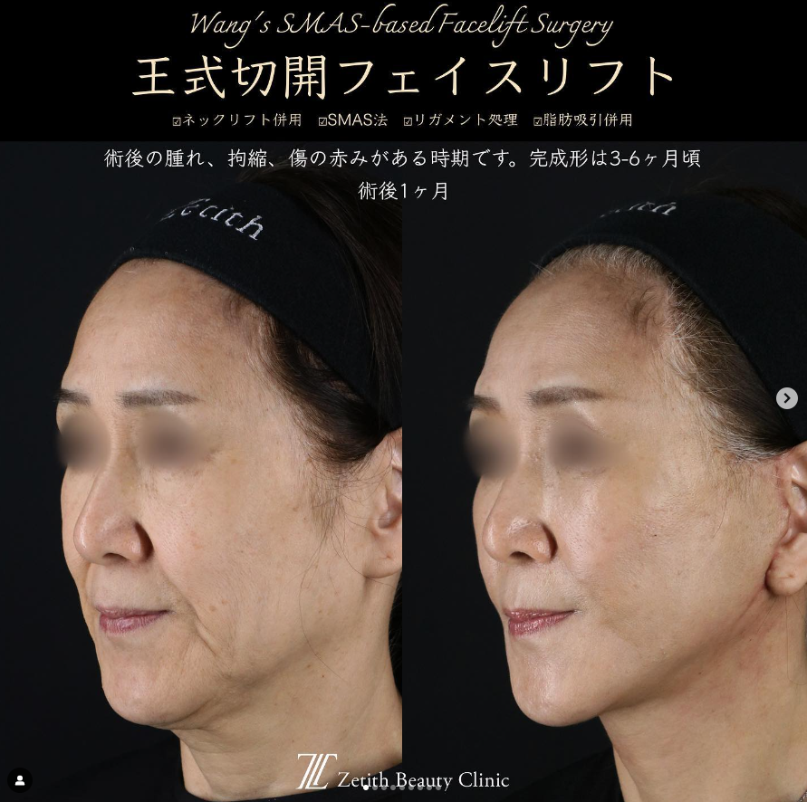 王医師による切開リフトの施術前／施術後1ヶ月