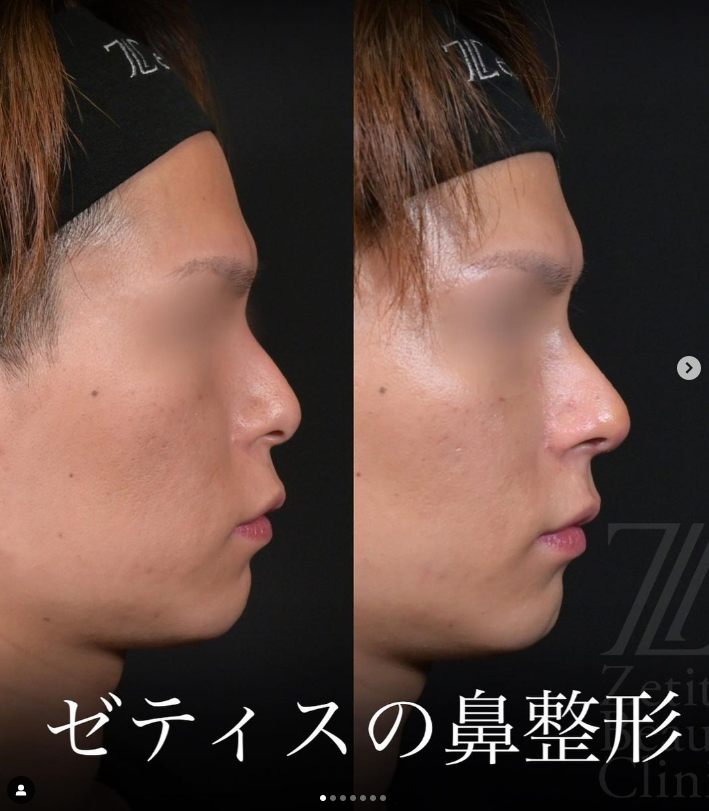 守屋医師による鼻整形の施術前／施術後1週間