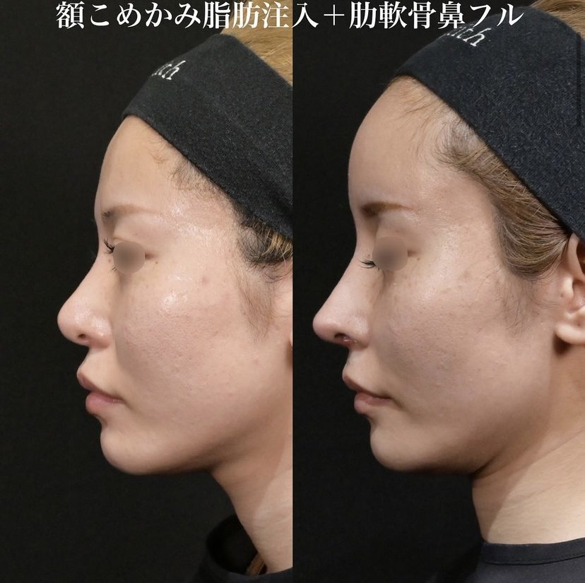 鉄医師による鼻整形の施術前／施術後1ヶ月