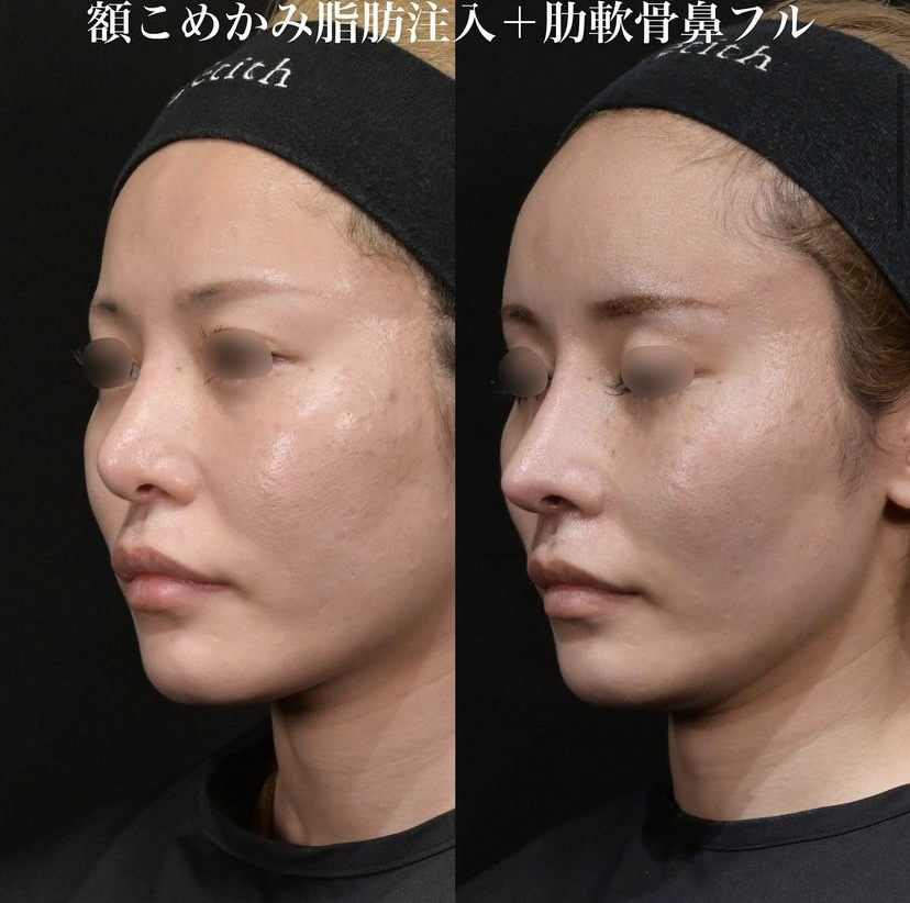 鉄医師による鼻整形の施術前／施術後1ヶ月 施術後 
