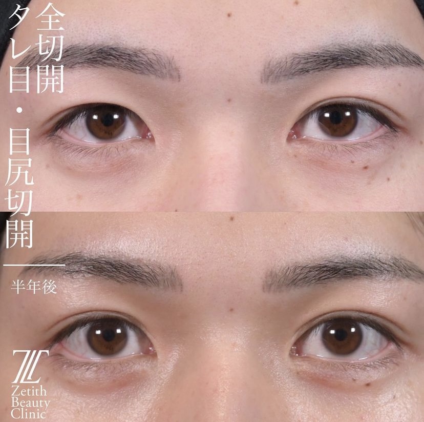 上木原医師による目元整形の施術前／施術後6ヶ月