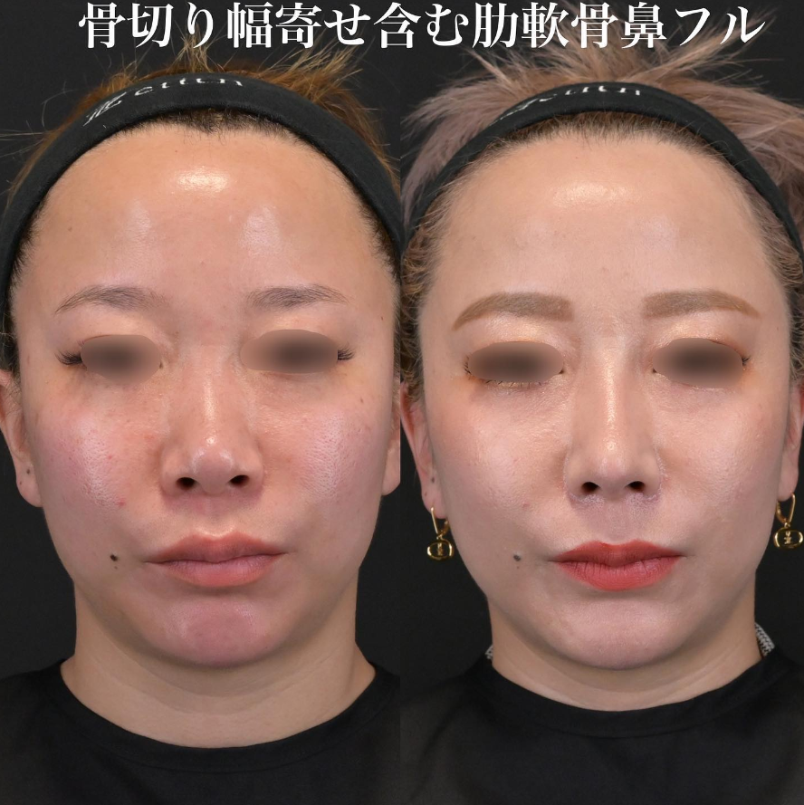 鉄医師による鼻整形の施術前／施術後1ヶ月