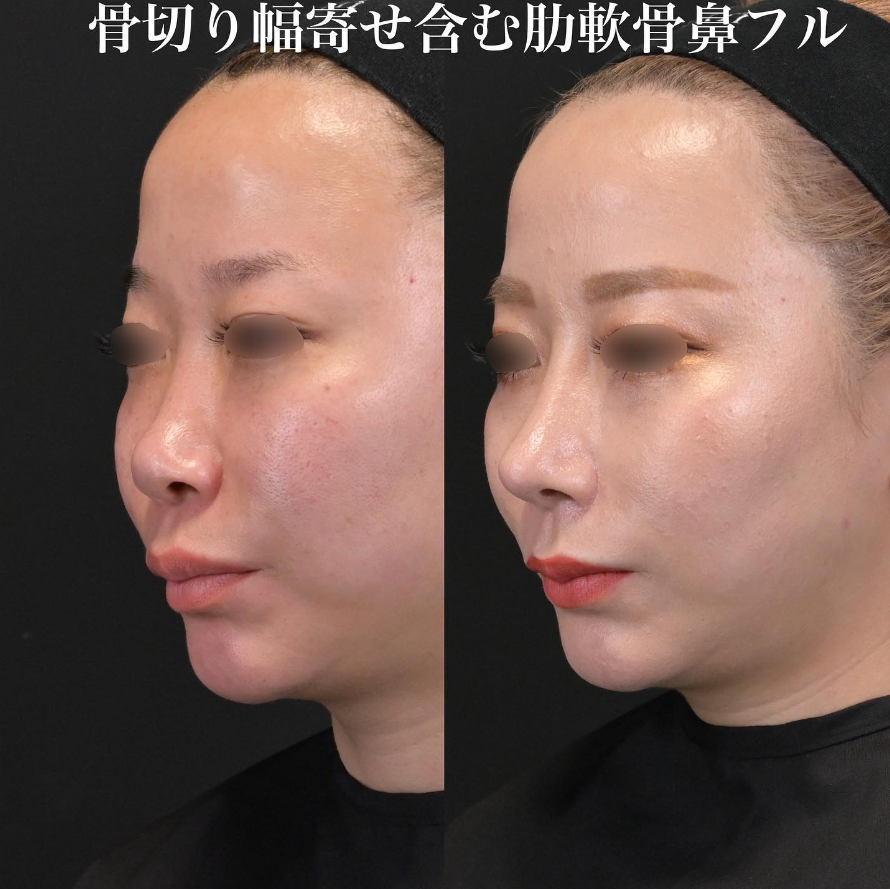 鉄医師による鼻整形の施術前／施術後1ヶ月 施術後 