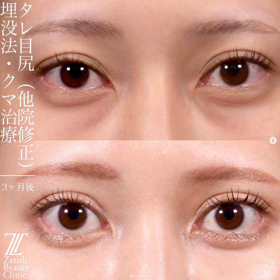 上木原医師による目元整形の施術前／施術後3ヶ月