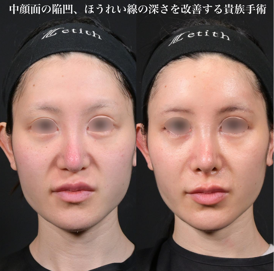 鉄先生による鼻整形の施術前／施術後1ヶ月