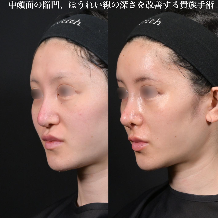 鉄先生による鼻整形の施術前／施術後1ヶ月 术后 
