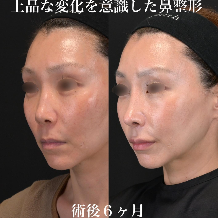 鉄医師による鼻整形の施術前／施術後6ヶ月